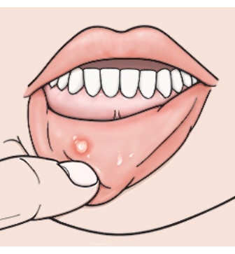 ماهي أنواع تقرحات الفم 
