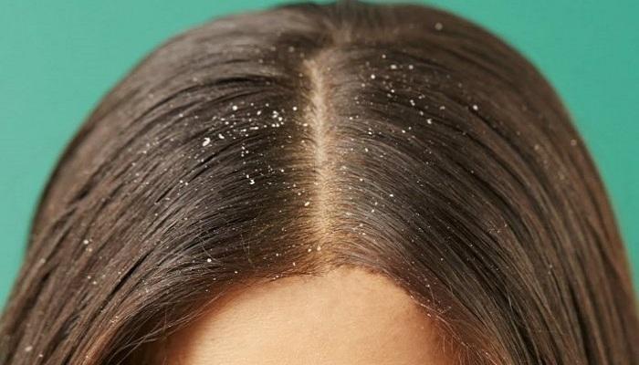 كيفية علاج قشرة الشعر